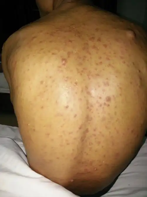 我舅舅背部皮肤上好多不明痘,是不是身体上有什么原因?