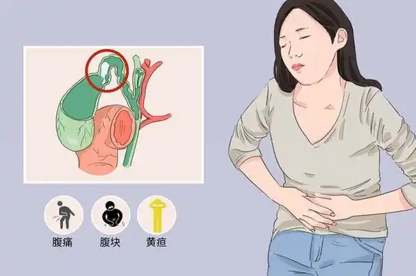 发生胆囊炎有什么症状表现?做好日常生活管理事项