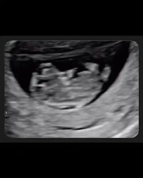 吴宗宪女儿吴姗儒宣布怀孕 晒b超照分享喜悦|吴姗儒|怀孕|吴宗宪_新浪