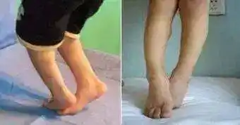 肌张力异常代表脑子有问题教你自测宝宝肌张力是否正常