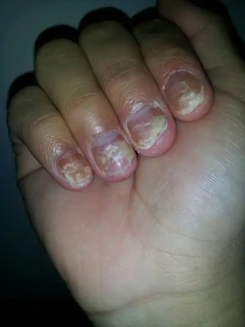 关与指甲的病.有图