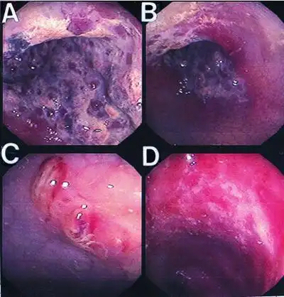 肛癌早期症状图片 (11)_有来医生