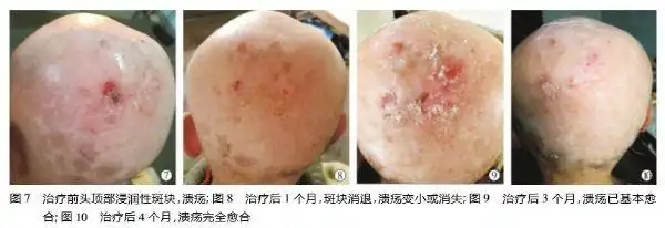 阿维a治疗头皮鳞状细胞癌1例