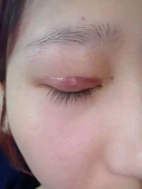 双眼皮消肿快与慢,与这几件事情做得好坏有直接的关系 - 好大夫在线