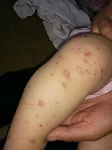 1岁宝宝身上起很大很多水泡