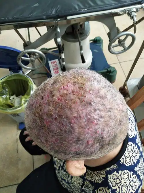 头皮多发性化脓性毛囊炎病例一例 - 皮肤及性传播疾病讨论版 - 爱爱医