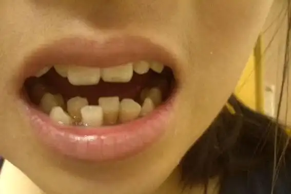 牙齿不齐怎么矫正才好?