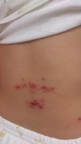 这个是带状疱疹吗? - 皮肤及性传播疾病讨论版 - 爱爱医医学论坛