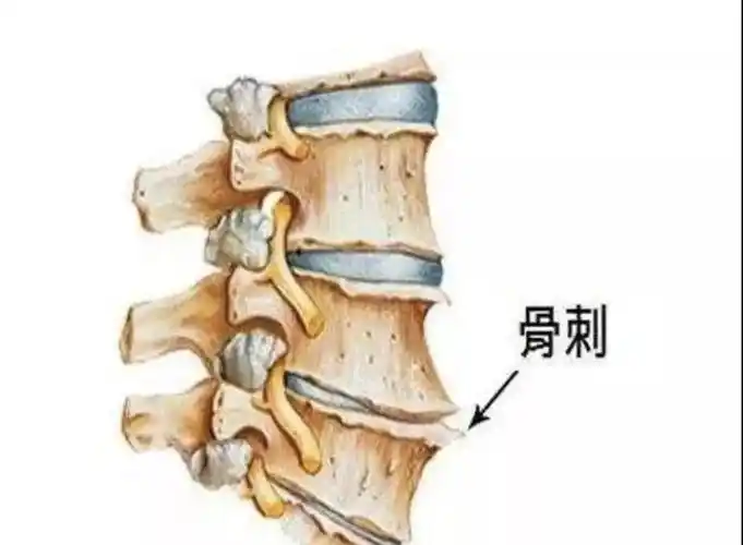 骨刺到底是怎么回事?疼痛和它其实没关系!
