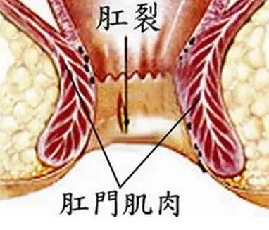 什么是肛裂肛裂的原因肛裂的治疗方法