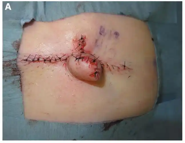 第423期-改良星形乳头再造法