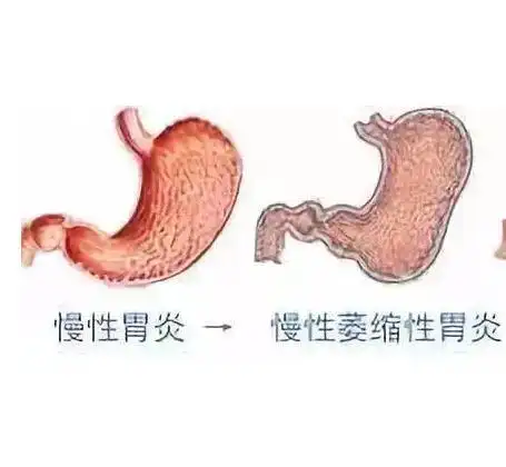慢性萎缩性胃炎是胃萎缩了吗?