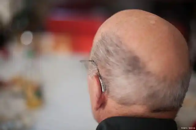 拿什么拯救你,我的地中海脱发!