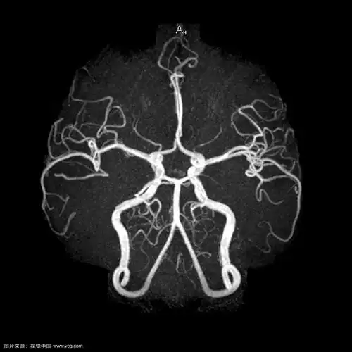 承德县医院1.5t核磁共振血管造影优势