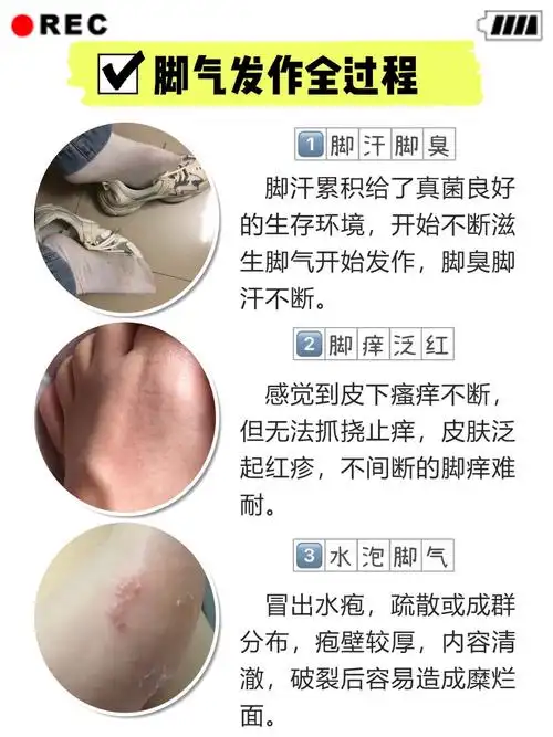 90后去除脚气的两年!