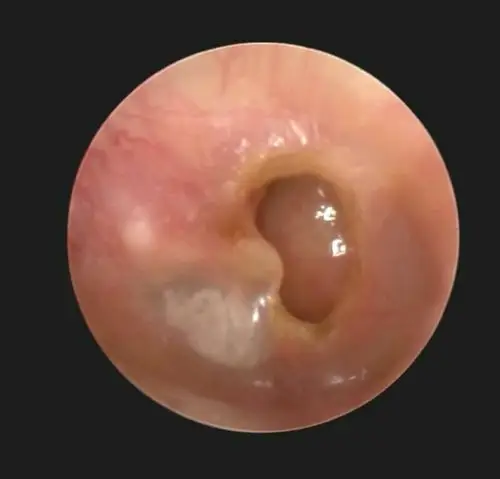 写美篇鼓膜紧张部穿孔 (中耳炎导致,鼓膜上有白色钙化斑)