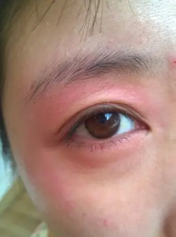 上眼皮周围发红,发痒,脱皮,有点肿,下面上图,反复好几次了,什么原因?