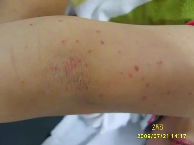 典型---变应性血管炎