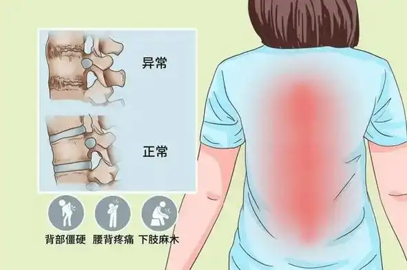 强直性脊柱炎,常见临床9个问答!