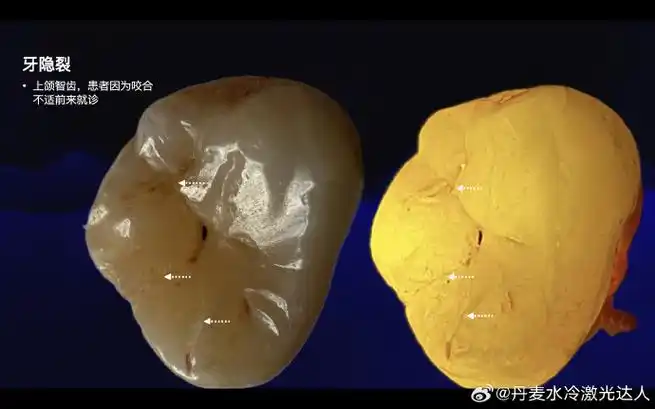 牙釉质##牙隐裂##牙本质##牙本质膜##nb口腔荧光照