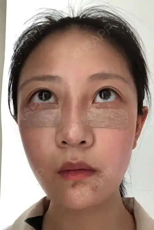 眶隔释放去眼袋术后1天_内切去眼袋术后1天_去眼袋术后1天_眼部整形术