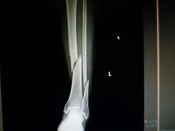 三例胫腓骨远端骨折