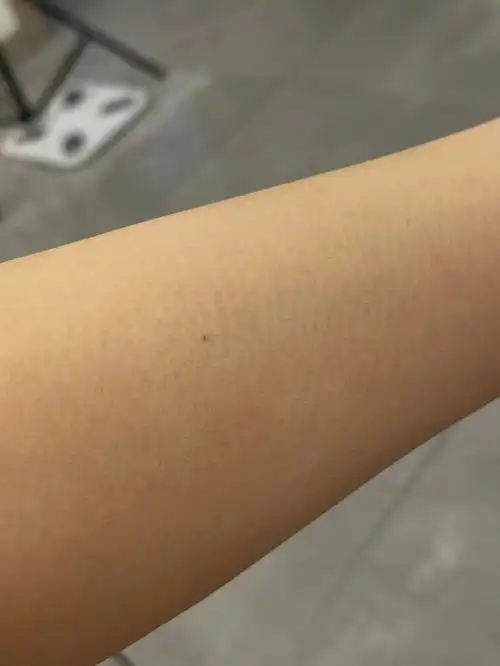 脱毛仪把我的痣点掉了2