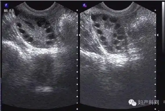 沉甸甸!双侧卵巢多囊样改变严重吗"可以选择"-第2张图片-飘零博客