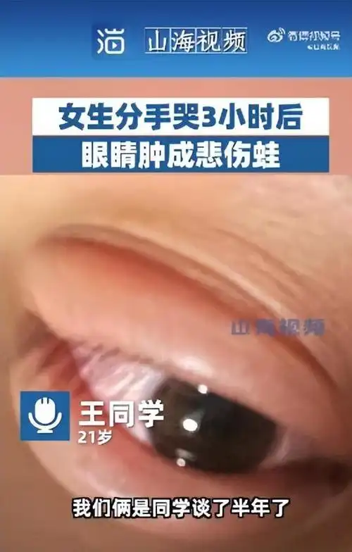 女生和男友吵架分手,哭3小时眼睛肿成"悲伤蛙":次日才消肿,拍照发给