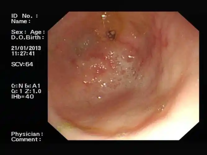 胃窦糜烂 (7)_有来医生