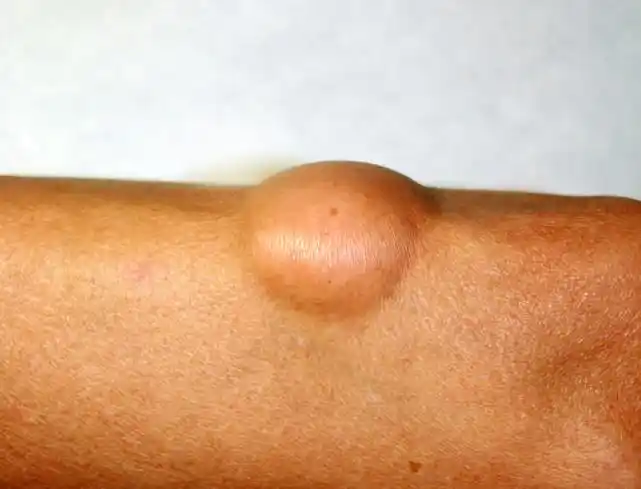 浑身几十个脂肪瘤男子质疑医生多收费坚持要局麻,结局很和谐_腾讯新闻