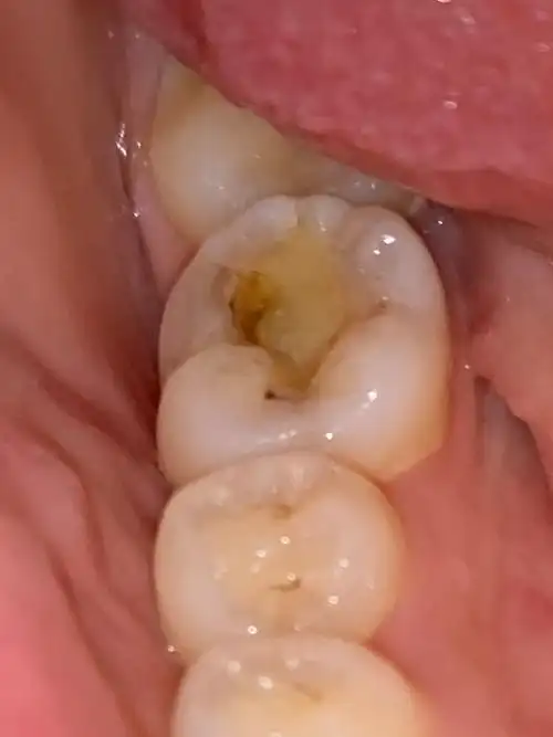 蛀牙有没有能看懂牙片的帮我看一下