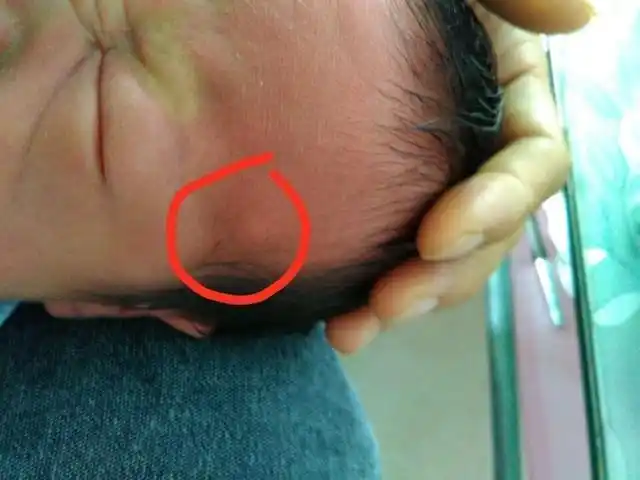 孩子左鬓角有个硬疙瘩,大夫说是粉瘤需要手术!急急急