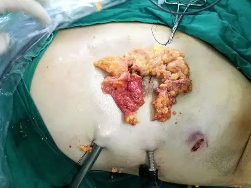 男性乳房发育微创治疗