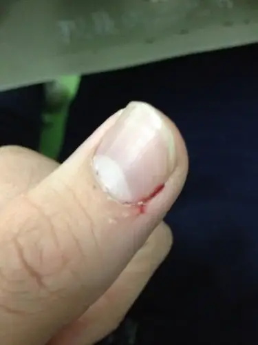 指甲流血,想问问是怎么回事?