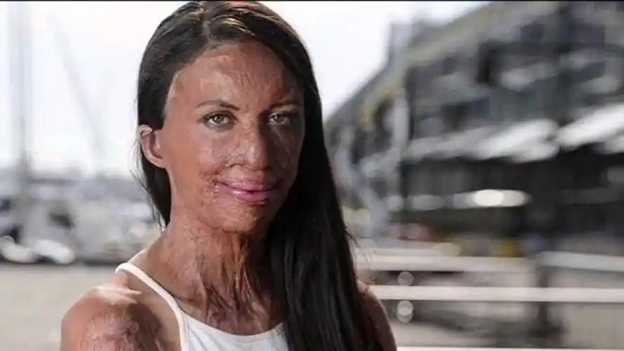 女子面部惨被烧伤骨架明显宛如骷髅脸却参加选秀走红