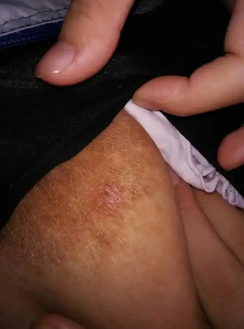 我乳房上有疙瘩还流脓呢!怎么回事呢!孩子还能吃奶吗