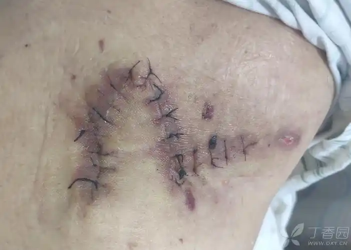 皮脂腺囊肿切除术后裂开的伤口,后续治疗经过