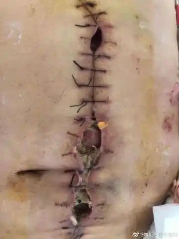 2020-11-10 来自 减肥手术超话