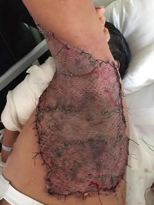 植皮术后一周,移植皮肤大部成活,术后一月随访创面完全愈合,功能无