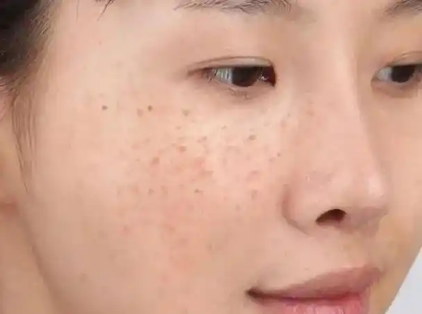 这种色素在人体皮肤表面聚集,就会形成老年斑一般年轻人体内有天然的