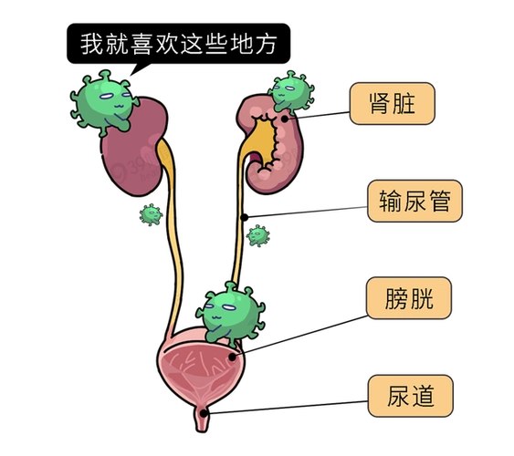 特别是当尿路感染患者出现寒战,高热,腰痛等症状时,表明感染已经较为