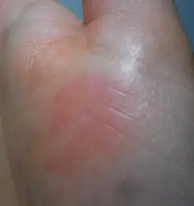 请懂中医的老师看看,手掌上一块红印?