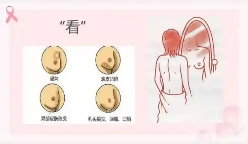 乳房的两边是否大小对称,有无不正常突起,有无"酒窝证"及"橘皮样"改变
