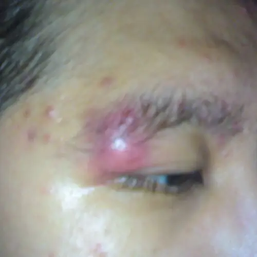 上眼皮部位的囊肿面部囊肿