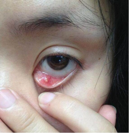 一分钟让你了解麦粒肿_麦粒肿_介绍_发病原因_症状表现_如何预防_治疗