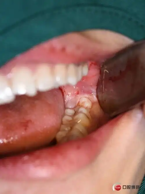 一次性微创拔除阻生智齿