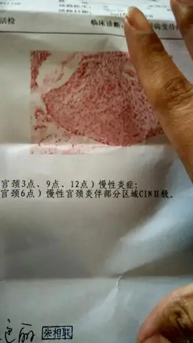 倒霉的我!慢性宫颈炎伴部分区域c i n2级