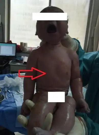 新生儿漏斗胸的诊断问题