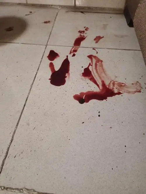 【讨论】后续 外伤有图慎入    一觉醒醒来 楼梯地板有血